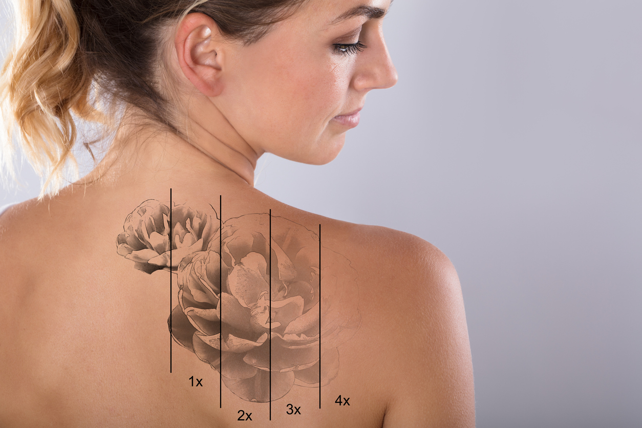 Tattoo Removal Victoria | by Victoria Natural Lines